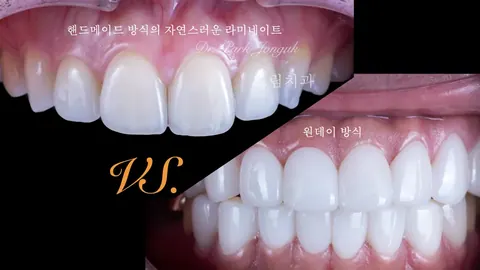 자연스러운 라미네이트, 인공적인 거랑 뭐가 다를까
