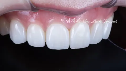 라미네이트 부작용 — 종류·원인·예방까지 한 번에