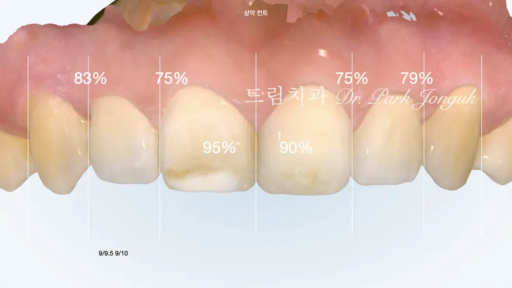 라미네이트 잘 하는 치과 고르는 법 — 진단부터 보증까지 6가지 기준 본문 사진 6