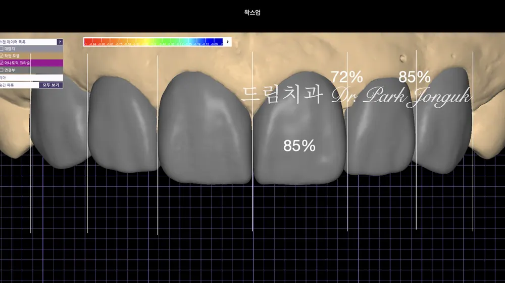 디지털 왁스업 정밀 진단