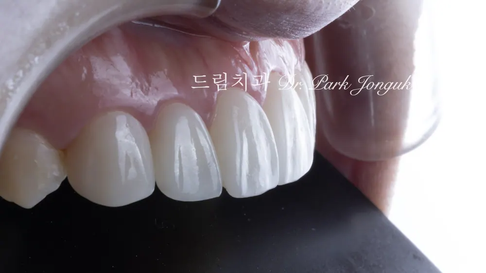 자연스럽게 마무리 된 무삭제 라미네이트 케이스