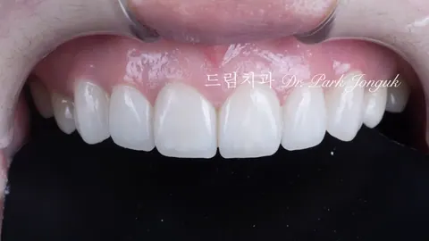 라미네이트 하면 치아 많이 깎나요? 시술 방식별 삭제량 정리