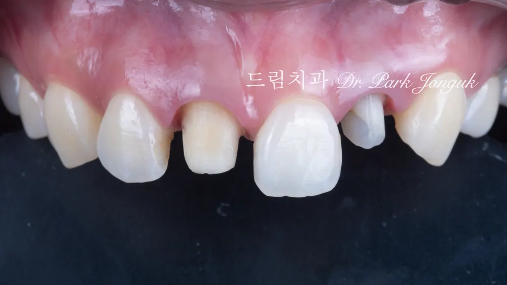 2개 치아에 대한 크라운. 라미네이트보다 삭제량이 훨씬 많음