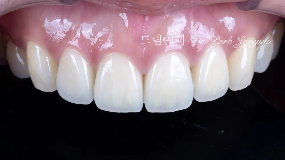 라미네이트 재시술 후 자연스러운 모습