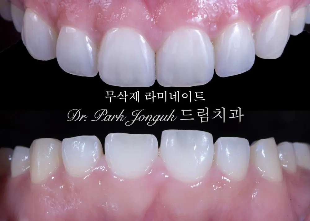 무삭제 라미네이트 케이스