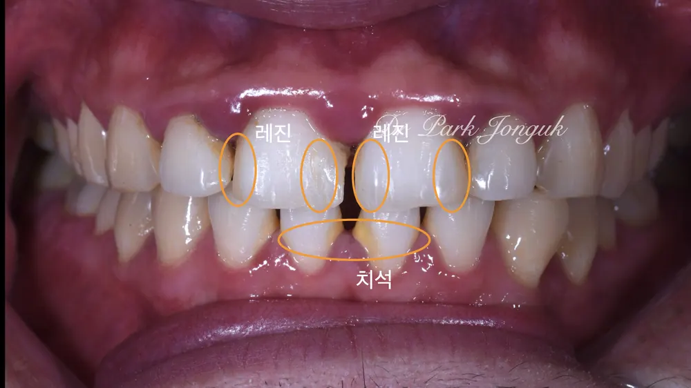 잇몸질환이 심각한 상태
