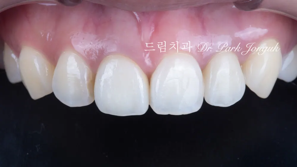 크라운을 통해 안정적인 색을 찾은 경우