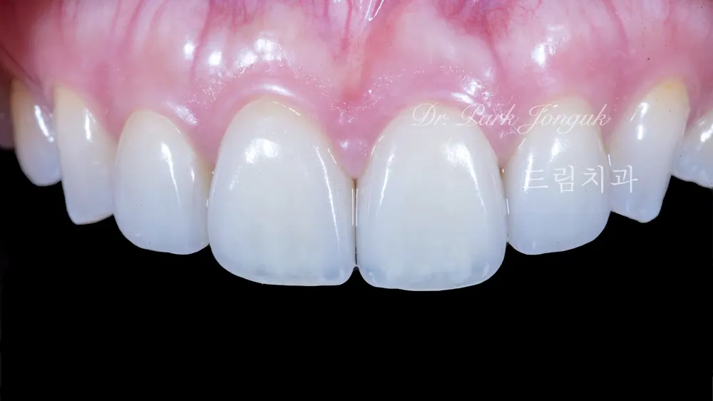 치아의 투명감을 살린 자연스러운 표현이 살아있는 라미네이트