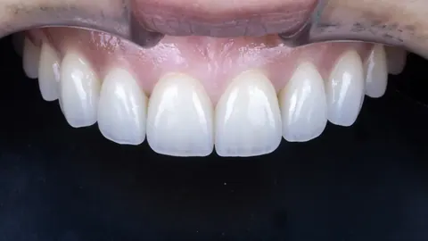 하얗기만 한 라미네이트는 왜 부자연스러워 보일까 - 빌드업 라미네이트 이야기