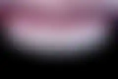 상악 8전치 미세삭제 라미네이트 치료 결과. 다층 빌드업으로 자연스러운 투명감을 살린 박종욱 원장 20년 임상 케이스 (로그인 후 조회 가능, 현재 흐림 처리)