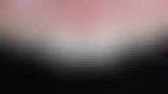 상악 2전치 라미네이트 재치료 결과. 물방울 레이저 제거 후 다층 빌드업 재시술 (로그인 후 조회 가능, 현재 흐림 처리)