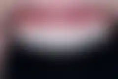 라미네이트 재시술 케이스 3 (재제작 후) (로그인 후 조회 가능, 현재 흐림 처리)