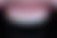 라미네이트 재시술 케이스 4 (재제작 후) (로그인 후 조회 가능, 현재 흐림 처리)